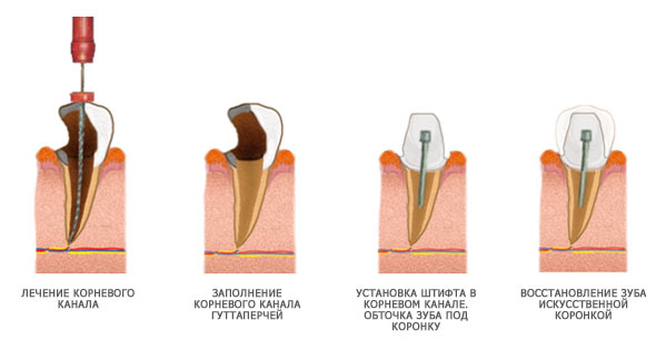 Этапы восстановления зуба